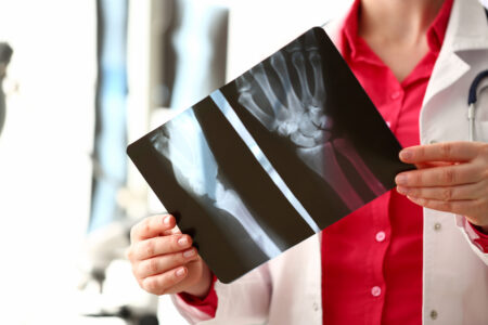Broken Bones